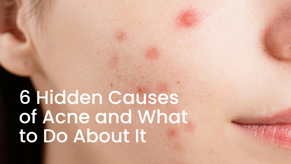 Causes of Acne and What to Do About It