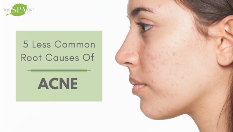 Root Causes Of Acne