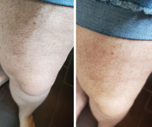 Before and After - dry skin on legs
